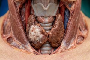 Cancers thyroïde