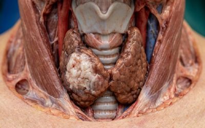 Cancers thyroïde