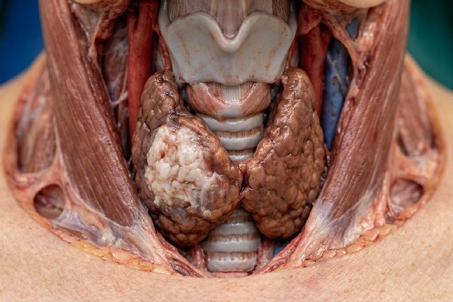 Cancers thyroïde